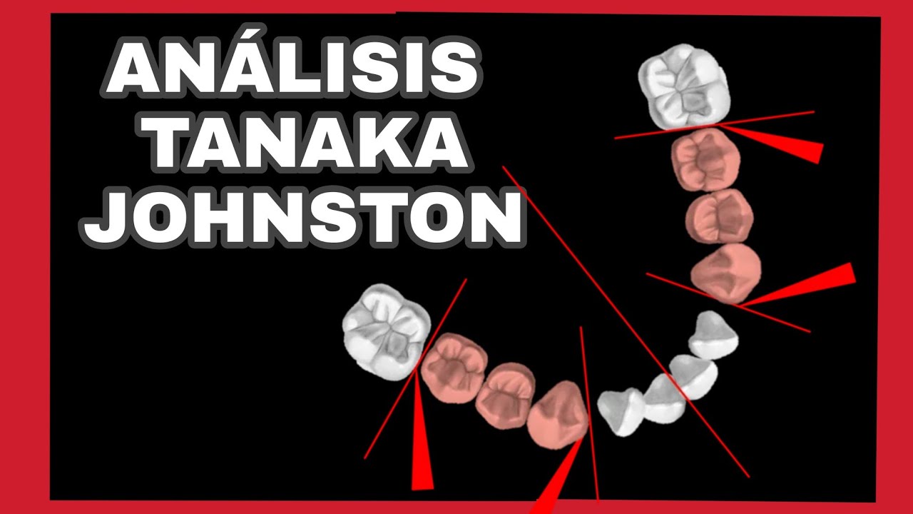 Análisis de Tanaka Johnston - Dentición mixta