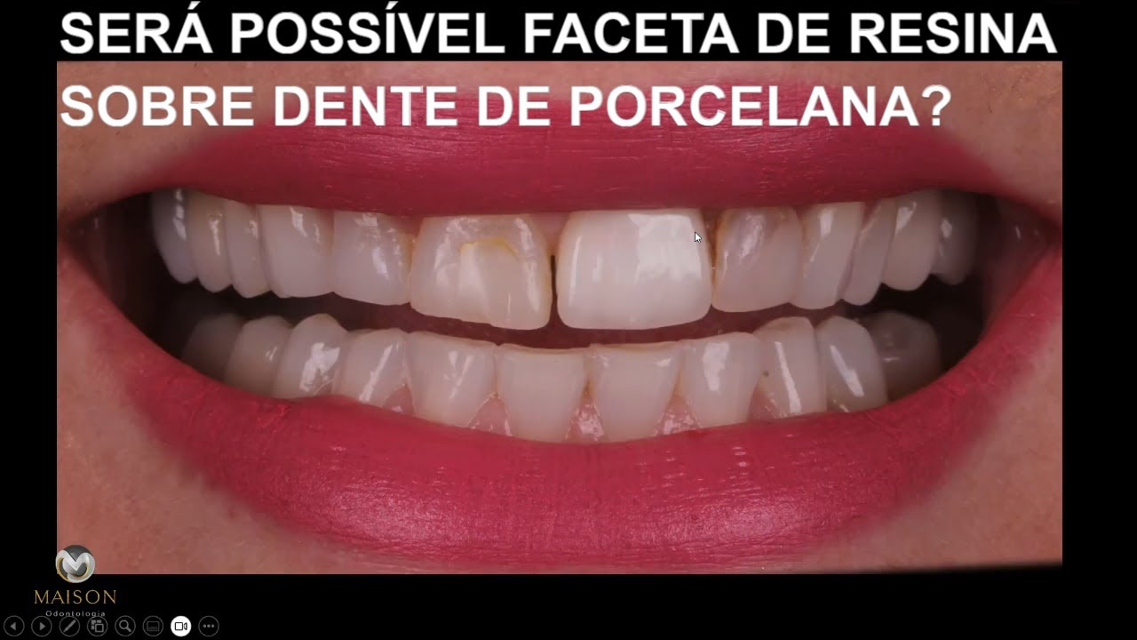 Facetas de Resina sobre Dente de porcelana - Será que é Possivel ?