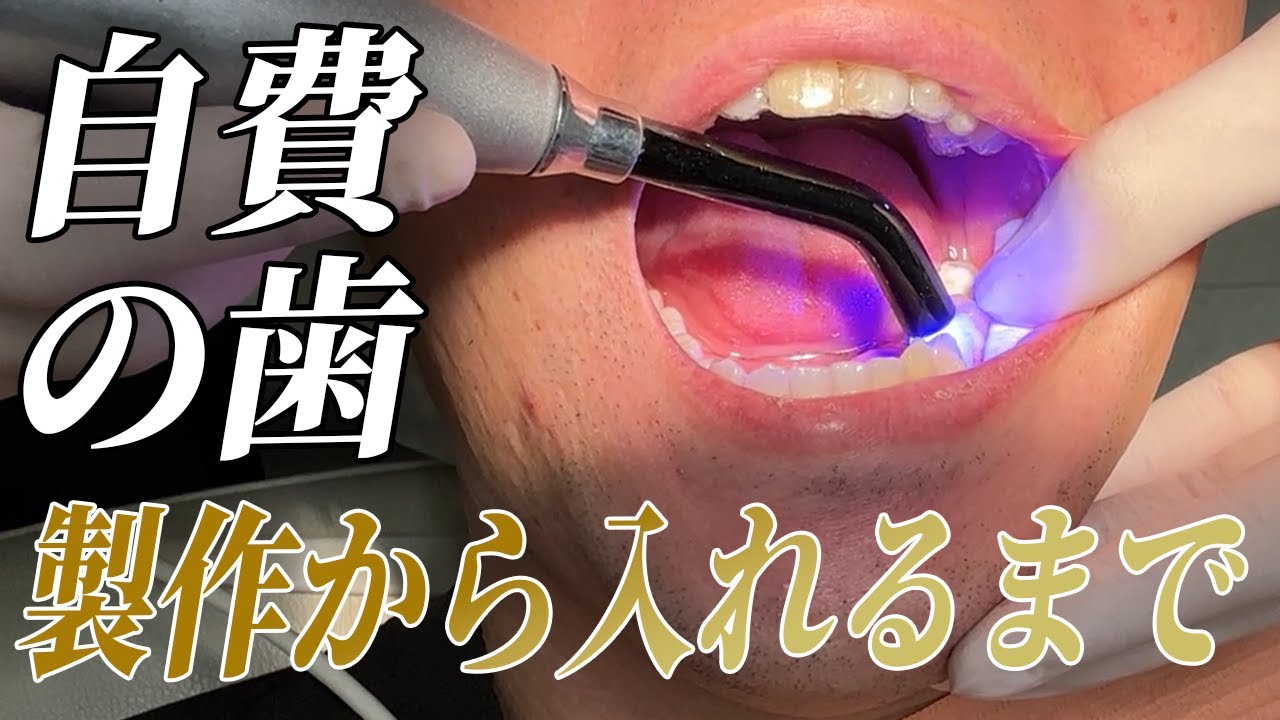 【本気治療】技工士登場！自費の詰め物の製作からお口の中に入れるまで