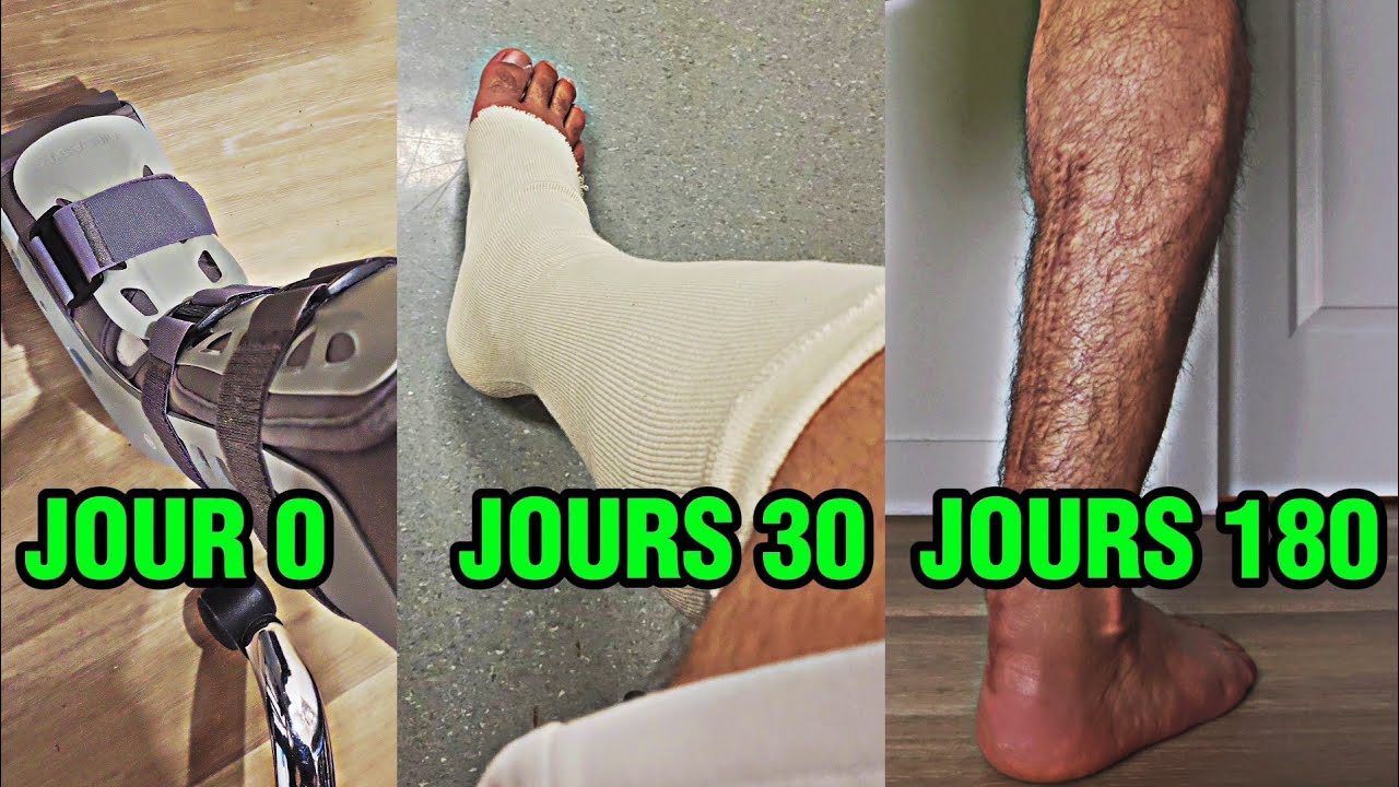 6 MOIS POST-RUPTURE : Exercices, Cardio, douleur, et PLUS #tendondachille