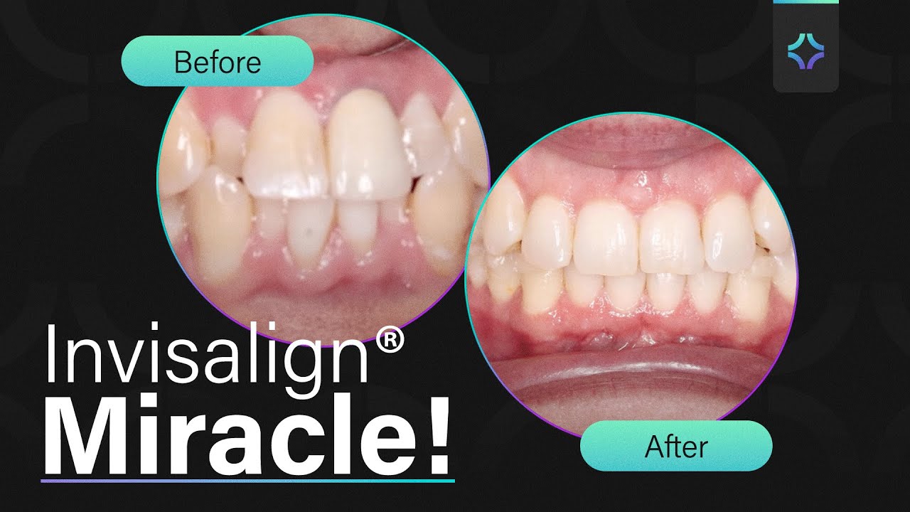 Impossible Smile Transformation Solved with Invisalign®! - Ep.1