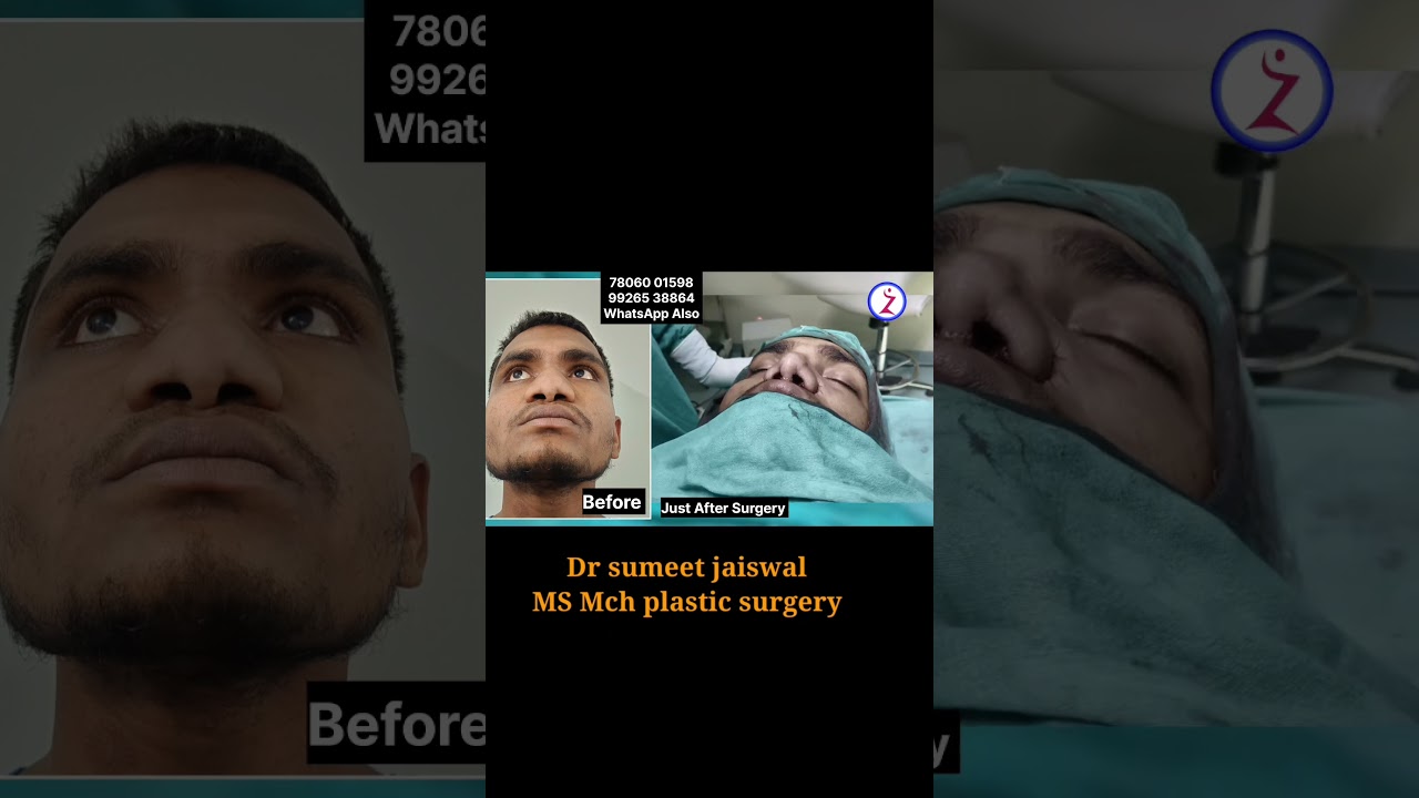 Nose cosmetic surgery india delhi bangalore hyderbad kolkata pune Mumbai chandigarh jaipur surat goa