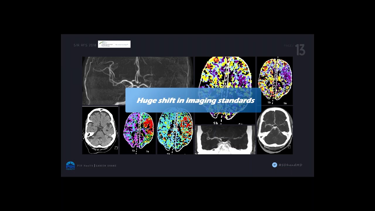 SIR-RFS Webinar (6/3/2018): An IR Perspective of stroke care and intervention