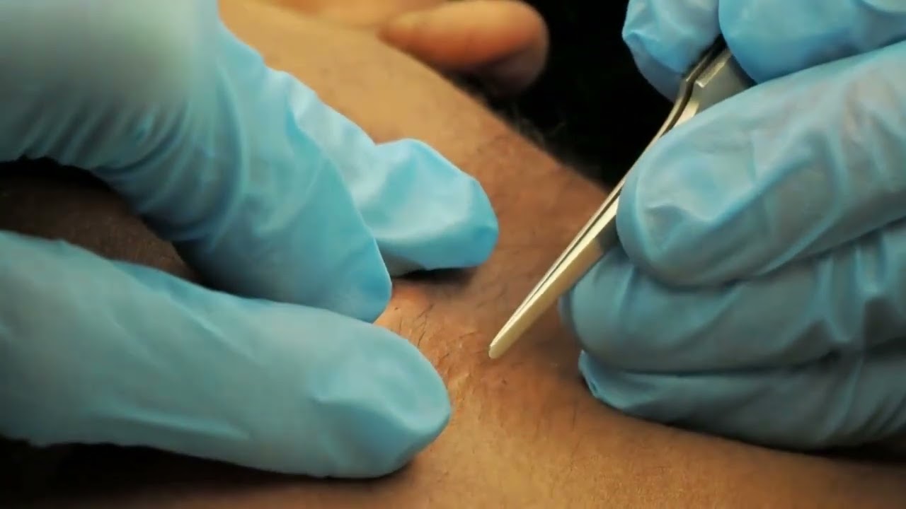 Dr Sobi Electrolysis Journey - Session 7