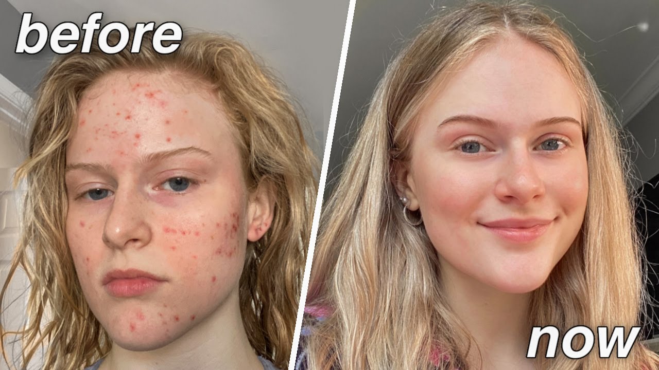 My Skin Care Routine | How I Cleared my Acne & got GLOWING Skin!