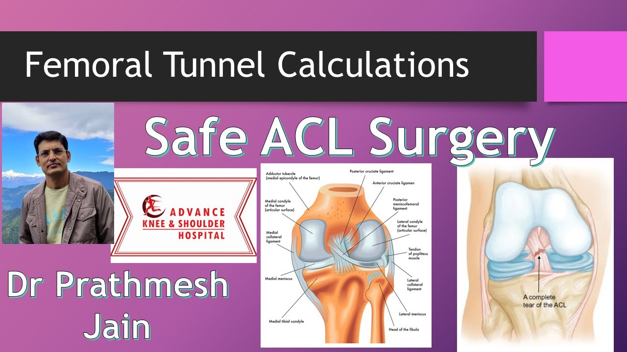 Femoral tunnel calculation In ACL surgery by Dr Prathmesh Jain ACL Expert (for orthopedic surgeons)