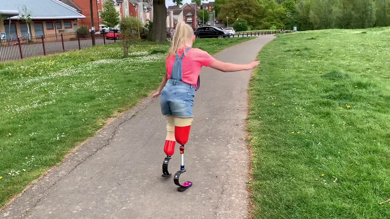 Double amputee does 40 cartwheels for charity