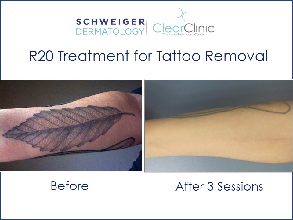 R20 Laser Tattoo Removal Technique