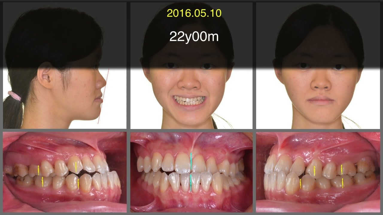 My perspective on Digital Orthodontics Part 3｜【Chris Chang Ortho】CC510