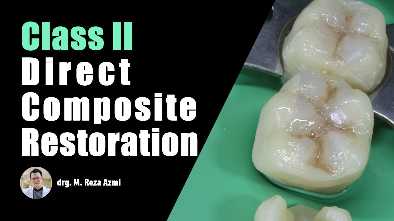 Class II Direct Composite Filling, Posterior Restoration | Operative Dentistry _ VOCO (Polofil NHT)
