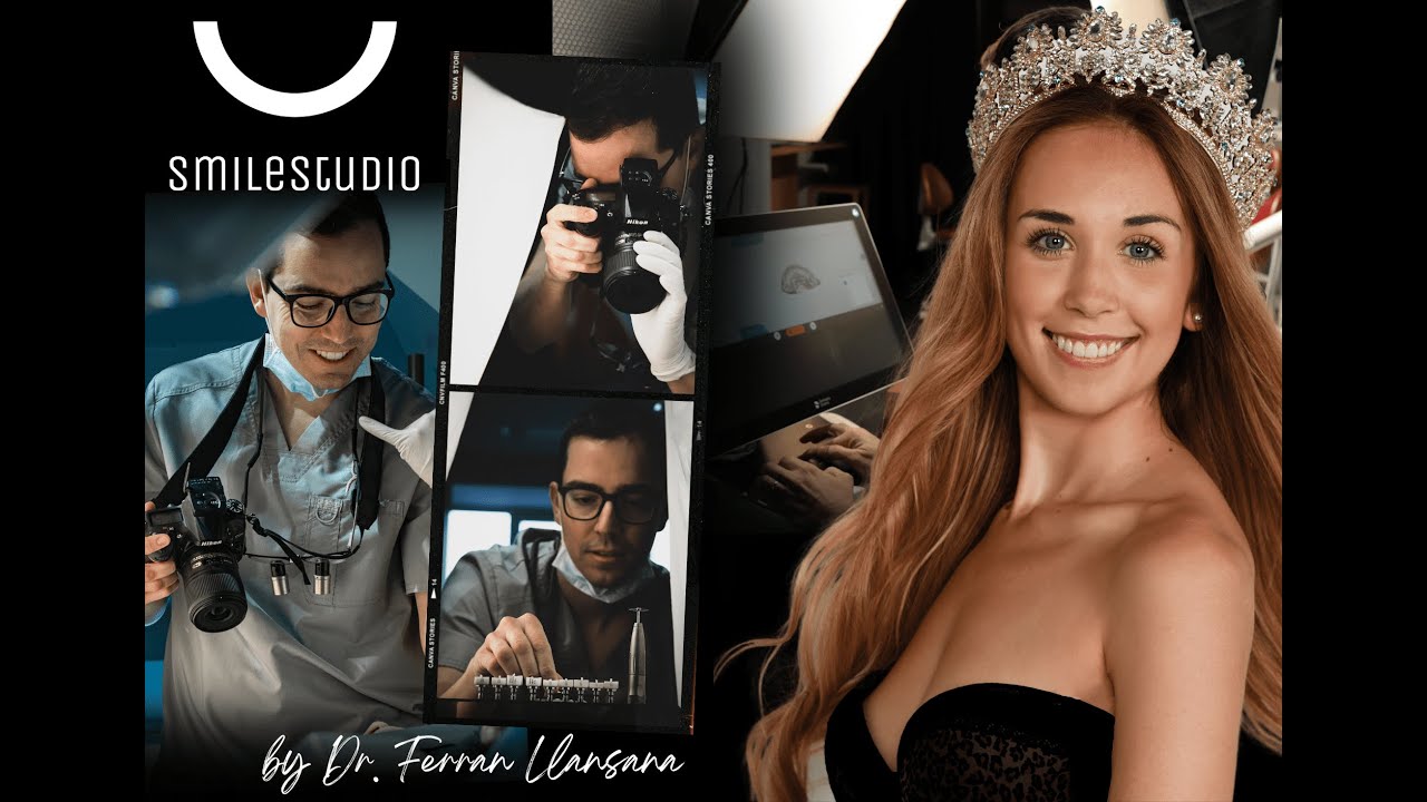 Diseño de sonrisa - Carillas dentales Miss Baleares 2023 - By. Dr. Ferran Llansana