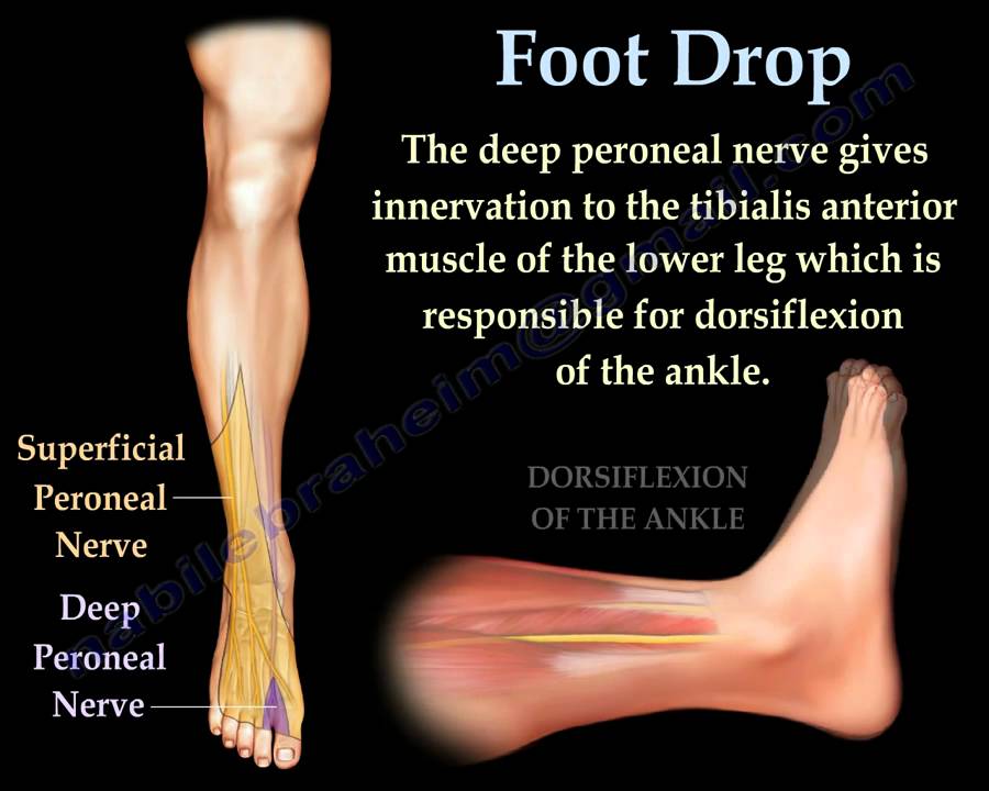 Foot Drop, Peroneal Nerve Injury - Everything You Need To Know - Dr. Nabil Ebraheim