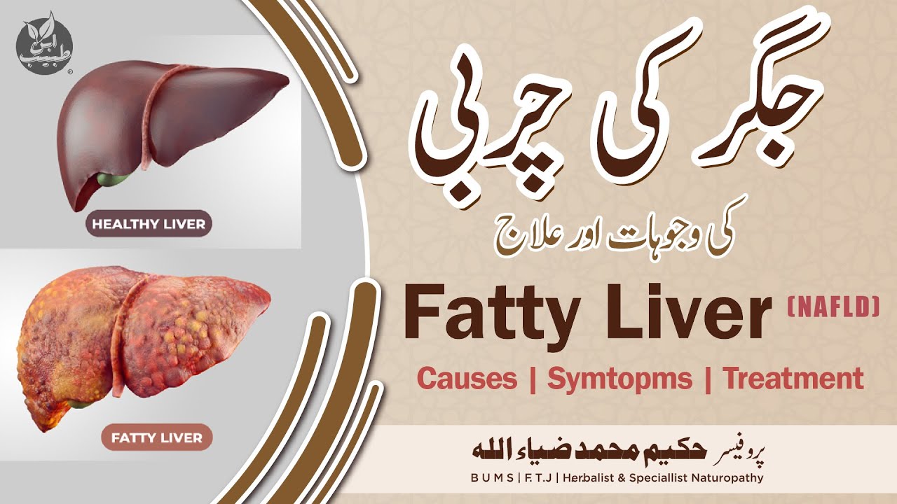 Fatty Liver (NAFLD) جگر کی چربی کی وجوہات اور علاج by Hakeem Muhammad Zia - IBN-E-TABEEB ® IBNE00147
