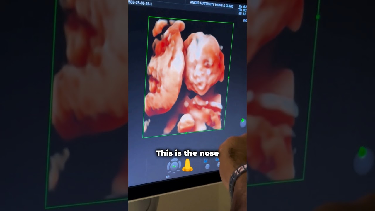 5-Month Baby Ultrasound | See the Face, Hands & More in 3D! Dr. Mohil Patel