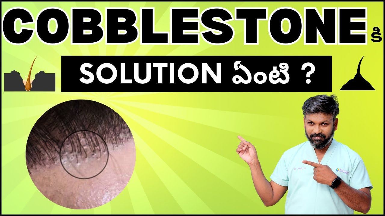 #AskDrJohnWatts | COBBLESTONE కి SOLUTION ఏంటి ? | Hair Specialist Explains