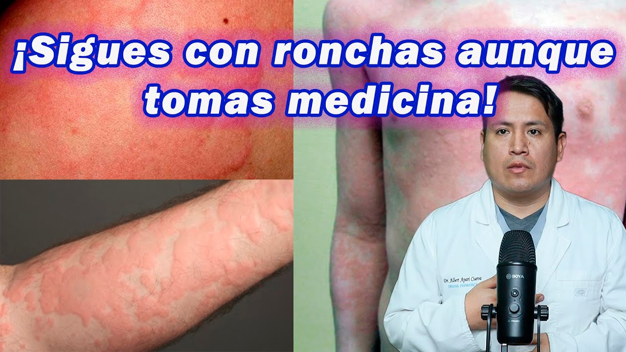 Urticaria crónica: causas ocultas que nadie te explica