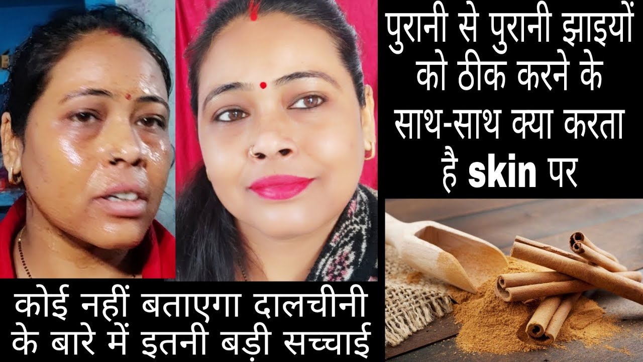 😆दालचीनी के इस्तेमाल से झाइयां तो ठीक होंगी लेकिन इसके बारे में सब कुछ जानना जरूरी है