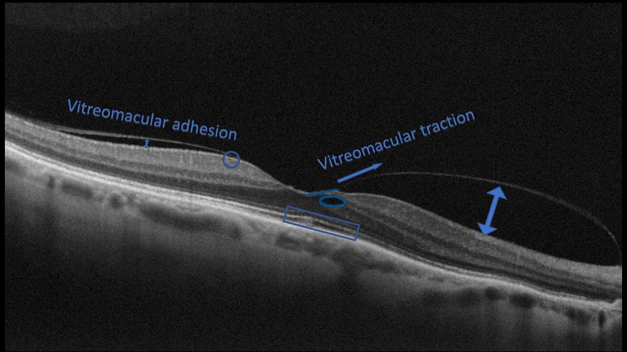 Course in clinical applications of OCT for macular diseases -Vitreomacular abnormalities part one