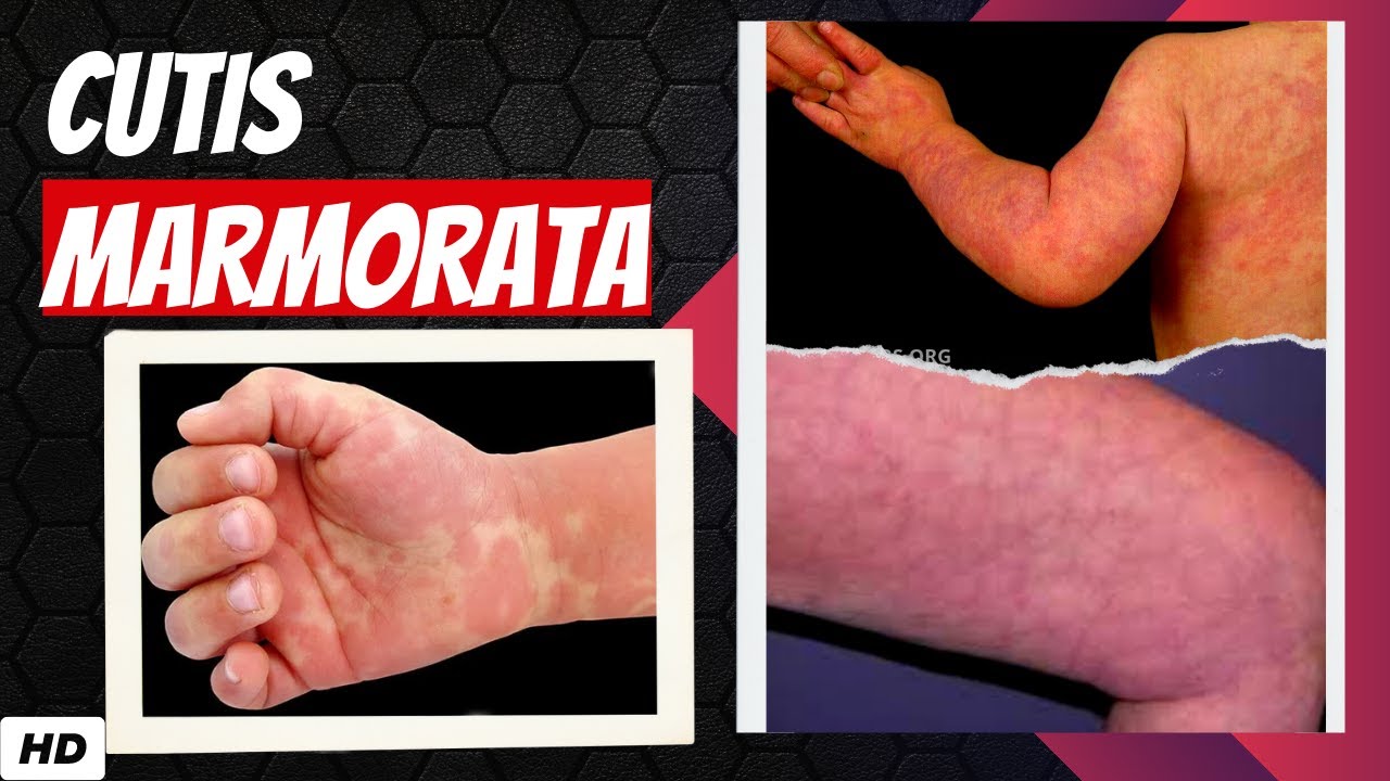 What is Cutis Marmorata?