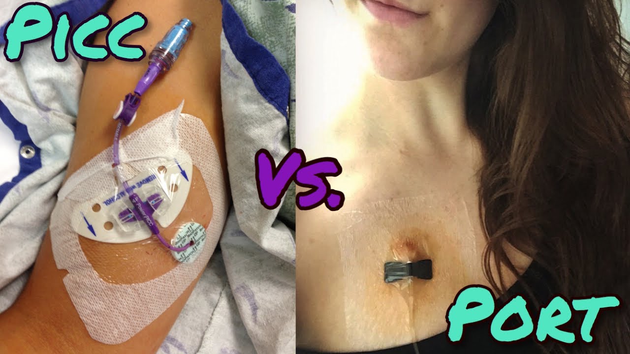Picc line v Port-a-cath | Pros/Cons, Procedure Prep, Tips & Tricks