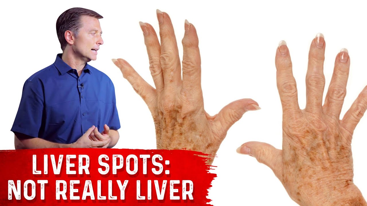 What Causes Liver Spots (Age Spots)? &ndash; Dr. Berg on Vitamin C Deficiency