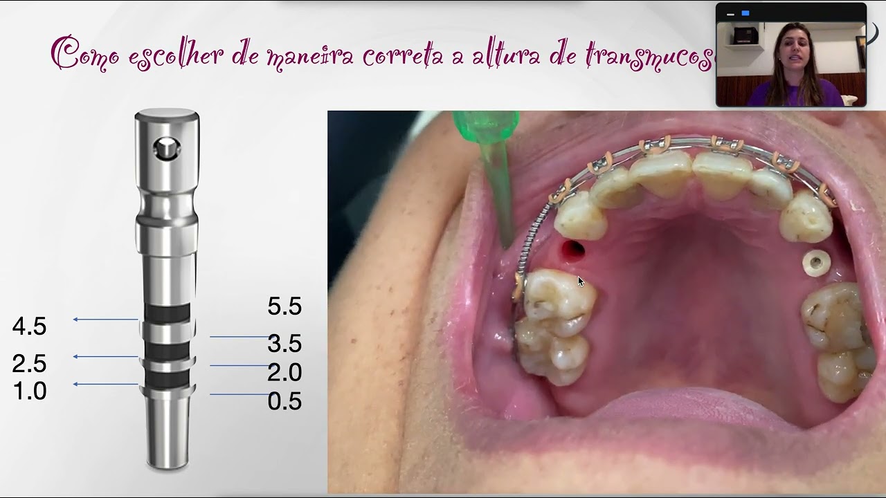 Como escolher a altura de transmucoso?