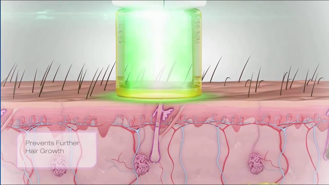 Gentle Laser Hair Removal Animation - Laser Hair Removal Florida