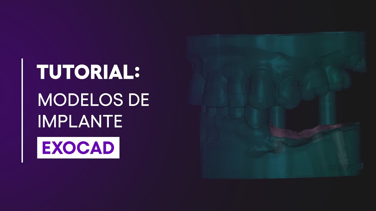 DOMINE O PROCESSO: GERANDO MODELOS DE IMPLANTE NO EXOCAD!