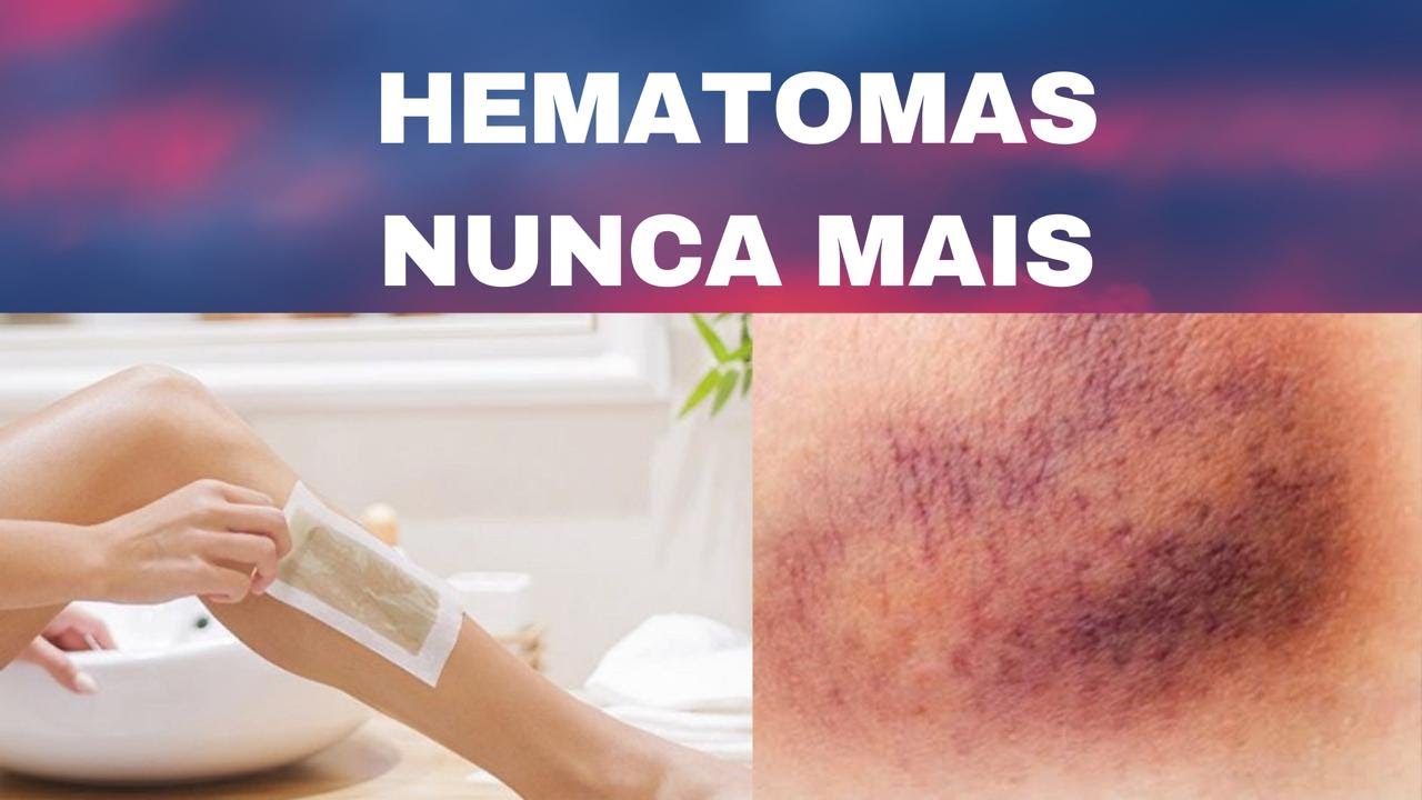 Como não deixar hematomas depilando com Roll-on.