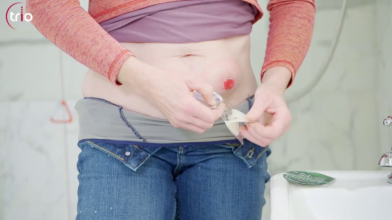How to Apply Silvex Silicone Convex Ostomy Seal? | Get flat 10% Off* | Shop Now Don't Miss Out!