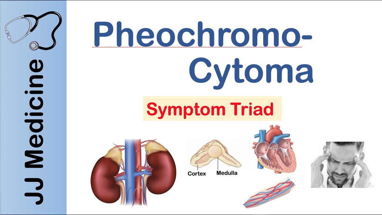 Pheochromocytoma | Symptoms and Treatment
