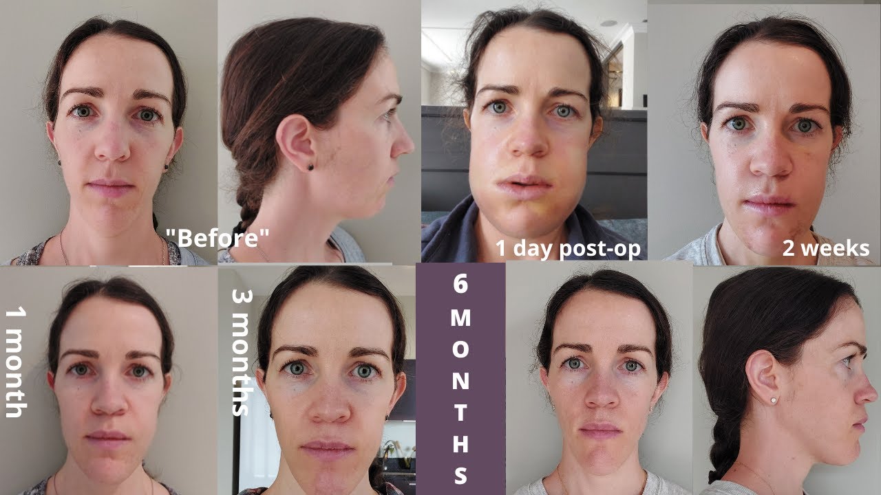 My Healing Journey: It's been 6 months!!! My double jaw surgery recovery recap (so far)...