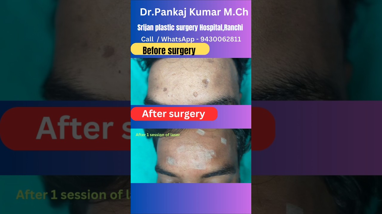 Chicken pox scar| Treatment of chicken pox scar in Ranchi #shorts #youtubeshorts