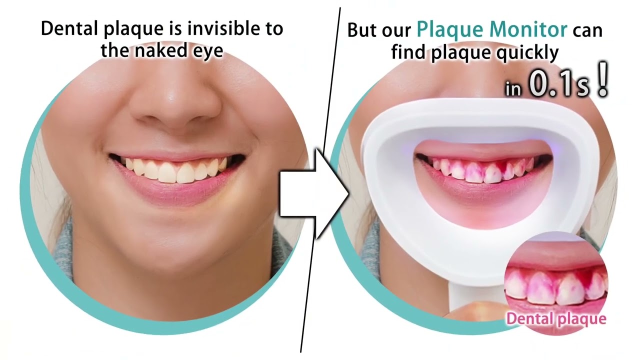 Dental Plaque Disclosing Monitor, Dental Tools to Show Plaque Instantly without Dye
