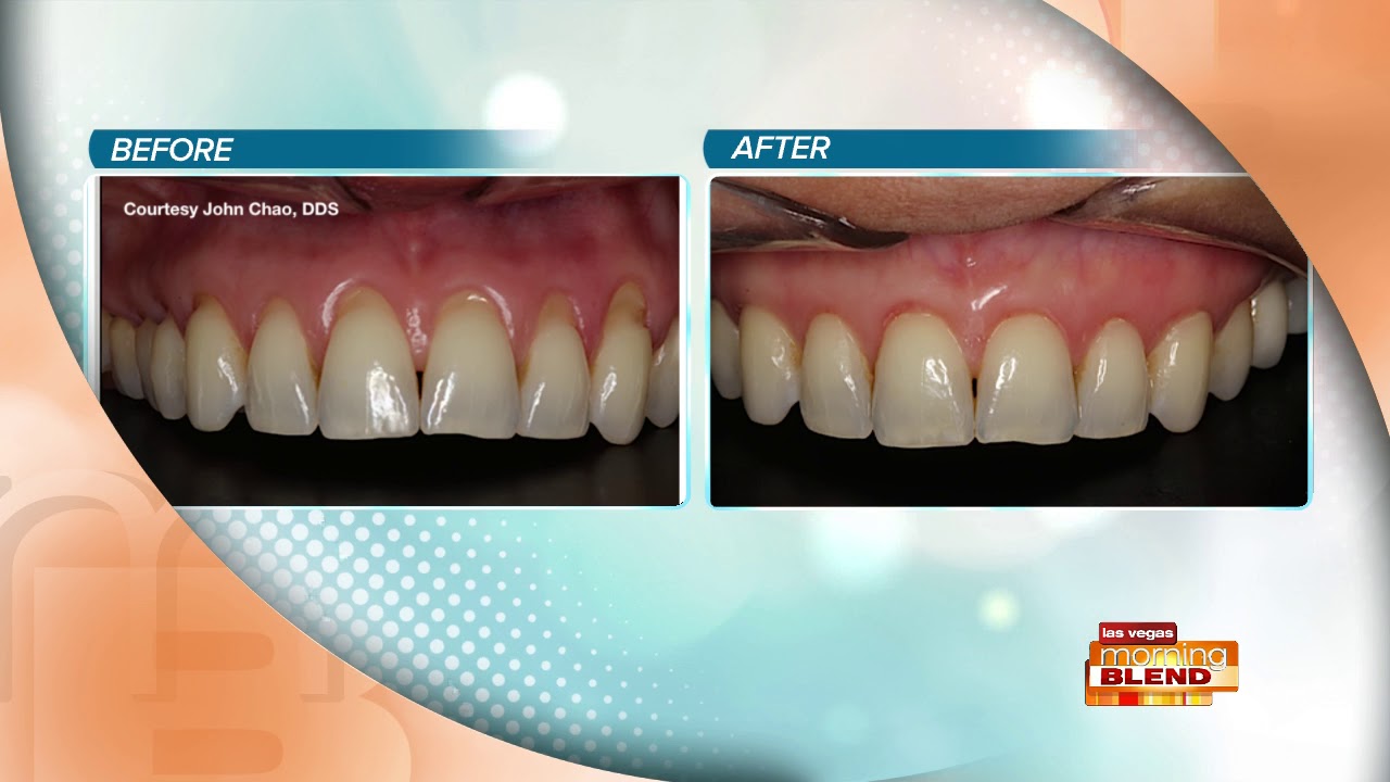 Chao Pinhole Gum Rejuvenation