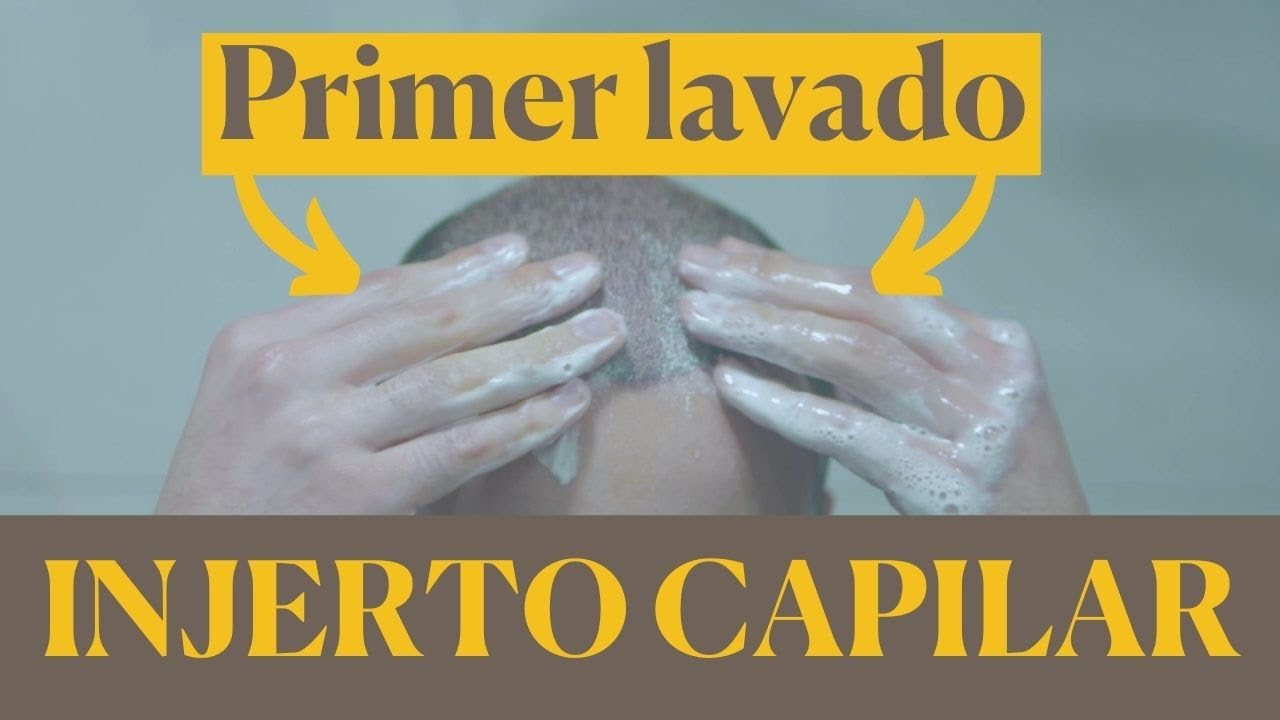 INJERTO CAPILAR ➤ Primer LAVADO ✅ CLAVES