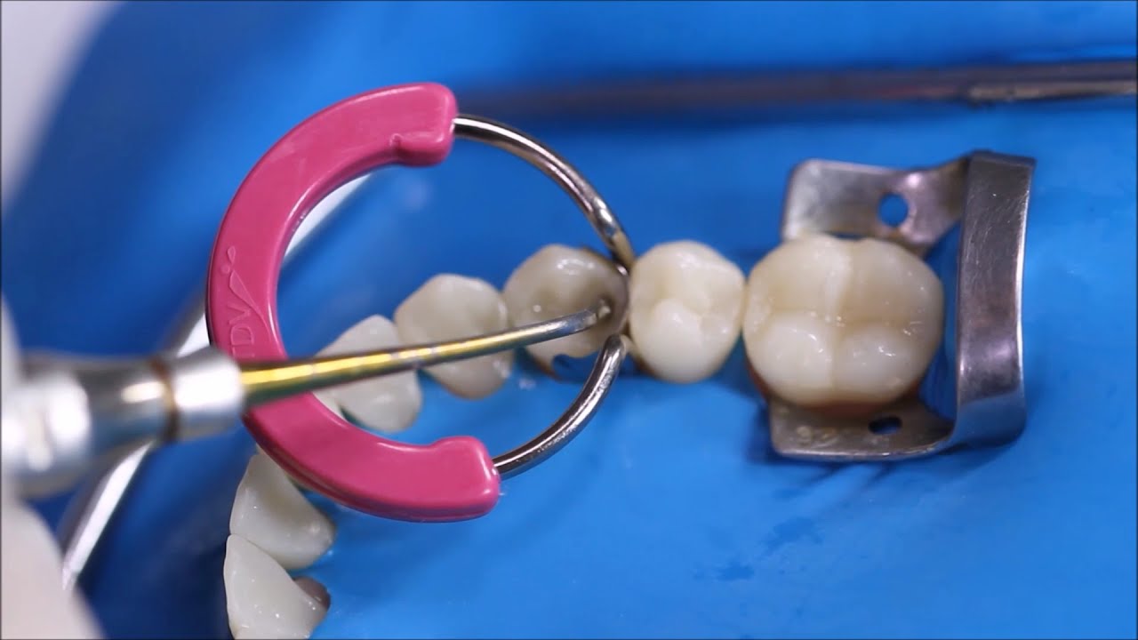 Restauração Cl II OD em RC no primeiro pré-molar inferior