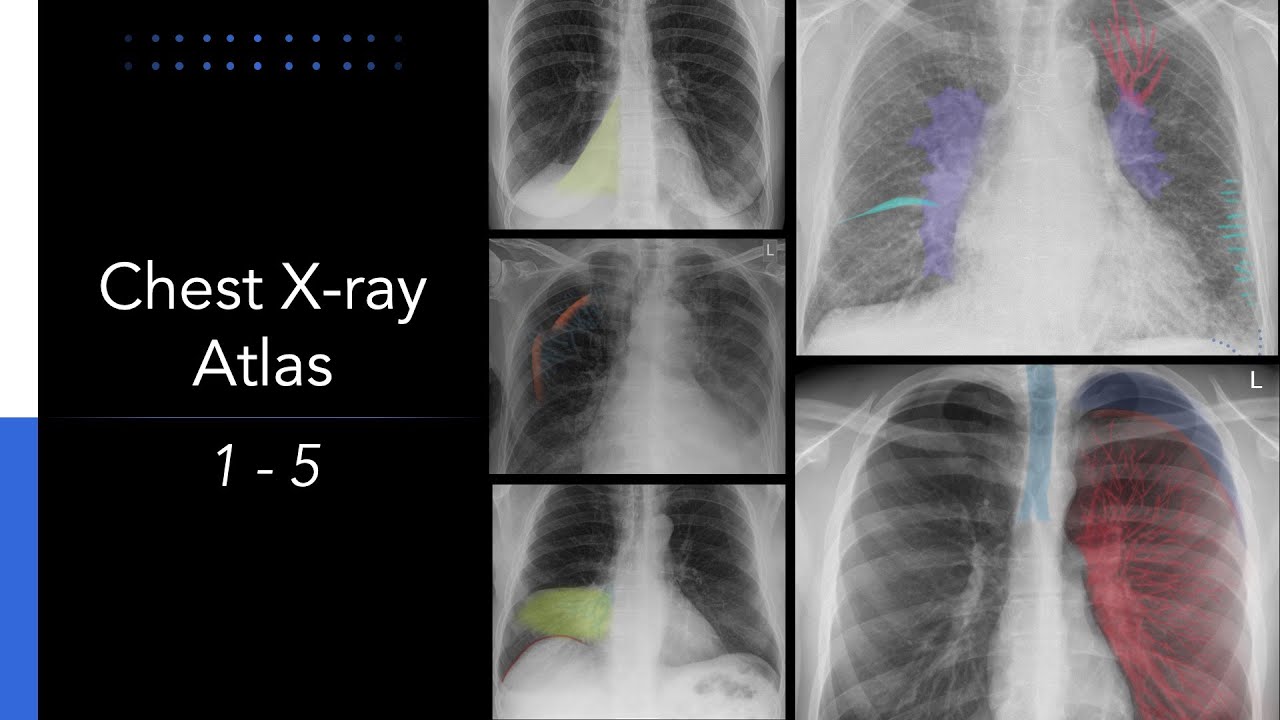 Chest X-ray Atlas: 5 Essential Chest X-rays for Students
