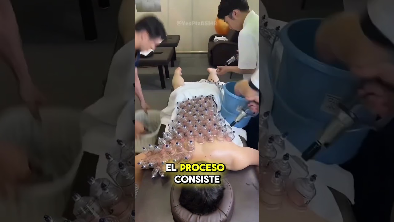 &iquest;Por qu&eacute; tiene tazas en la espalda? Descubre la terapia de ventosas