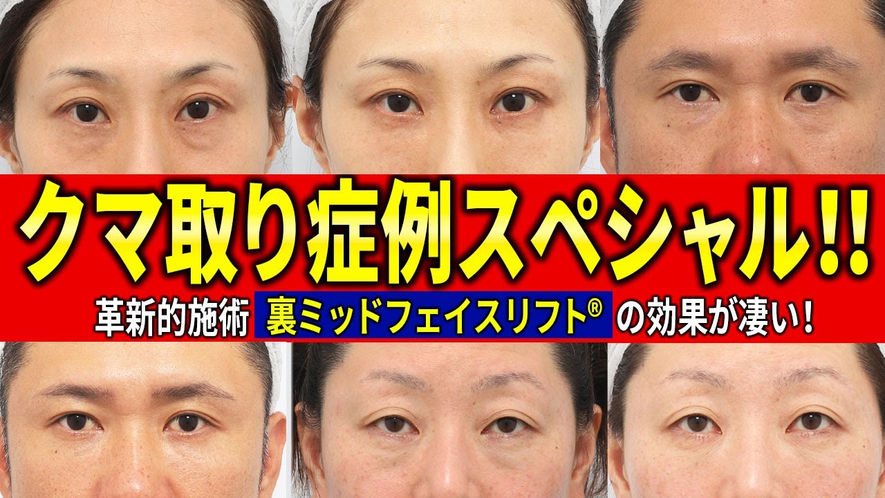 【症例イッキ見】唯一無二のクマ取り施術！裏ミッドフェイスリフトの症例が一気に見れます！中顔面の引き上がりで若返り効果が凄かった！