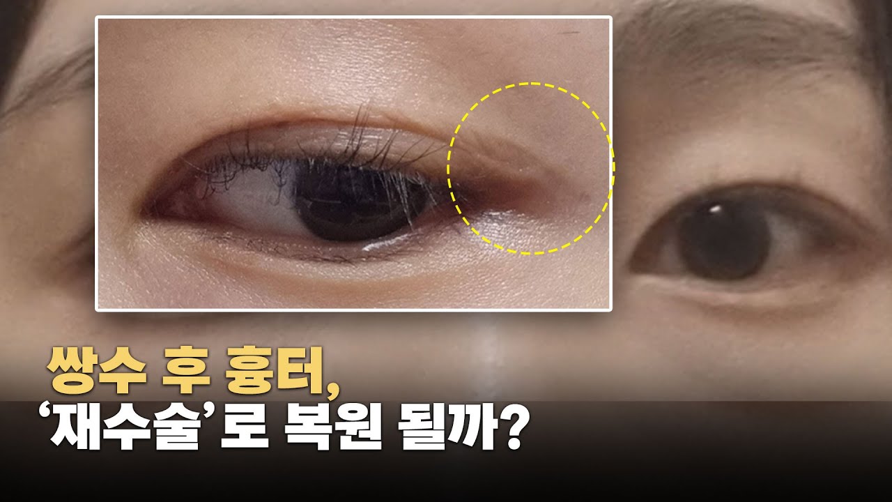 쌍꺼풀 흉터, 재수술로 다시 없앨 수 있을까요?(온라인 성형상담)