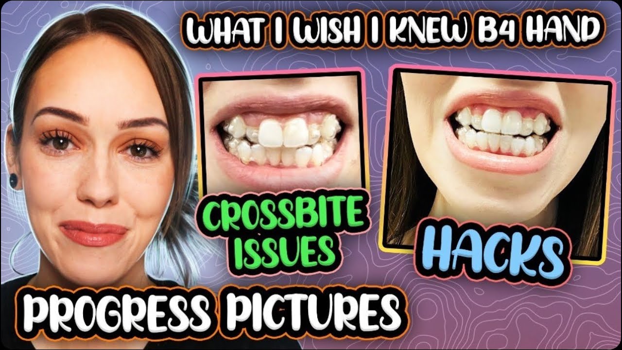 Invisalign Progress | Hacks | Do & Don'ts