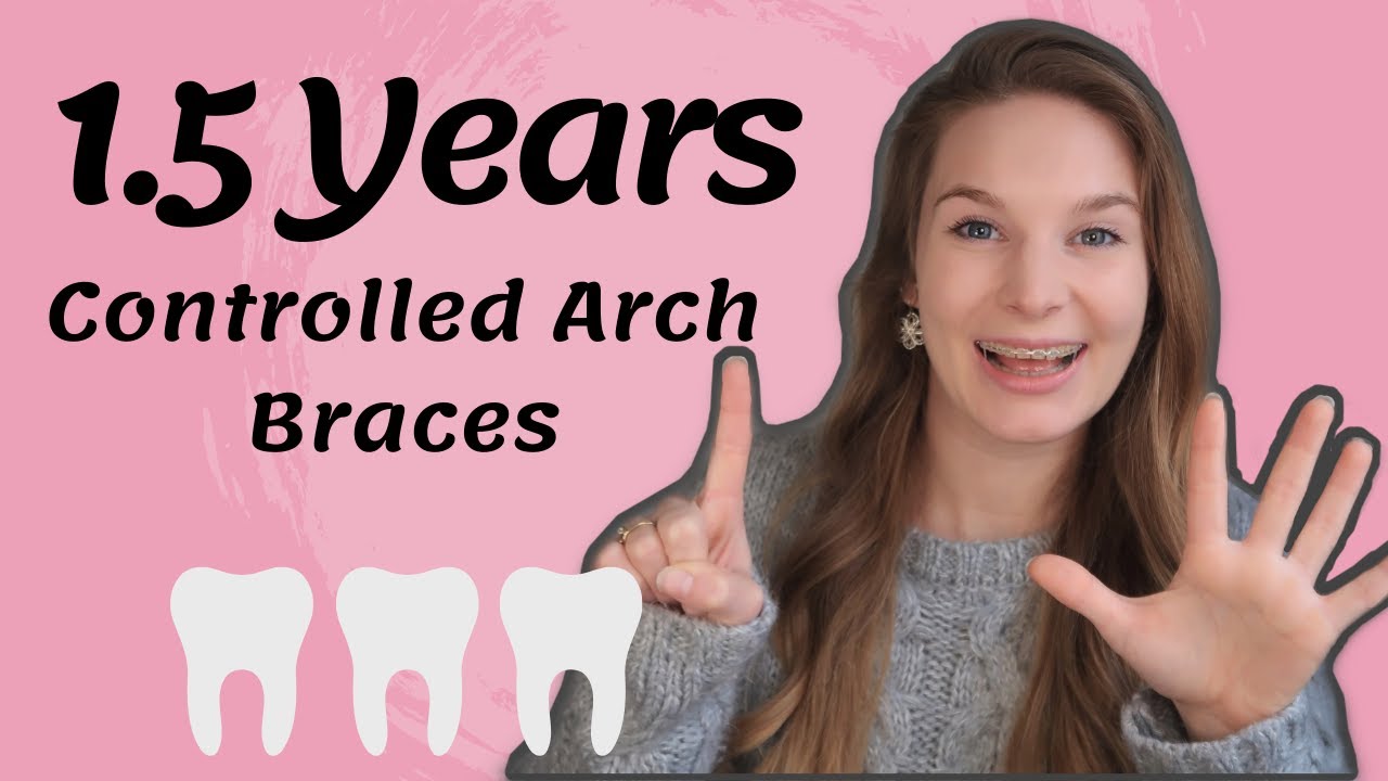 1.5 Years Update | Controlled Arch Braces