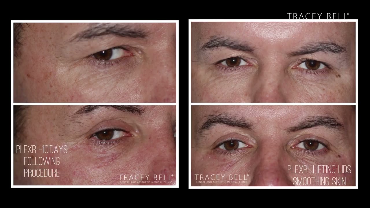 Plexr Plus before and after real results.