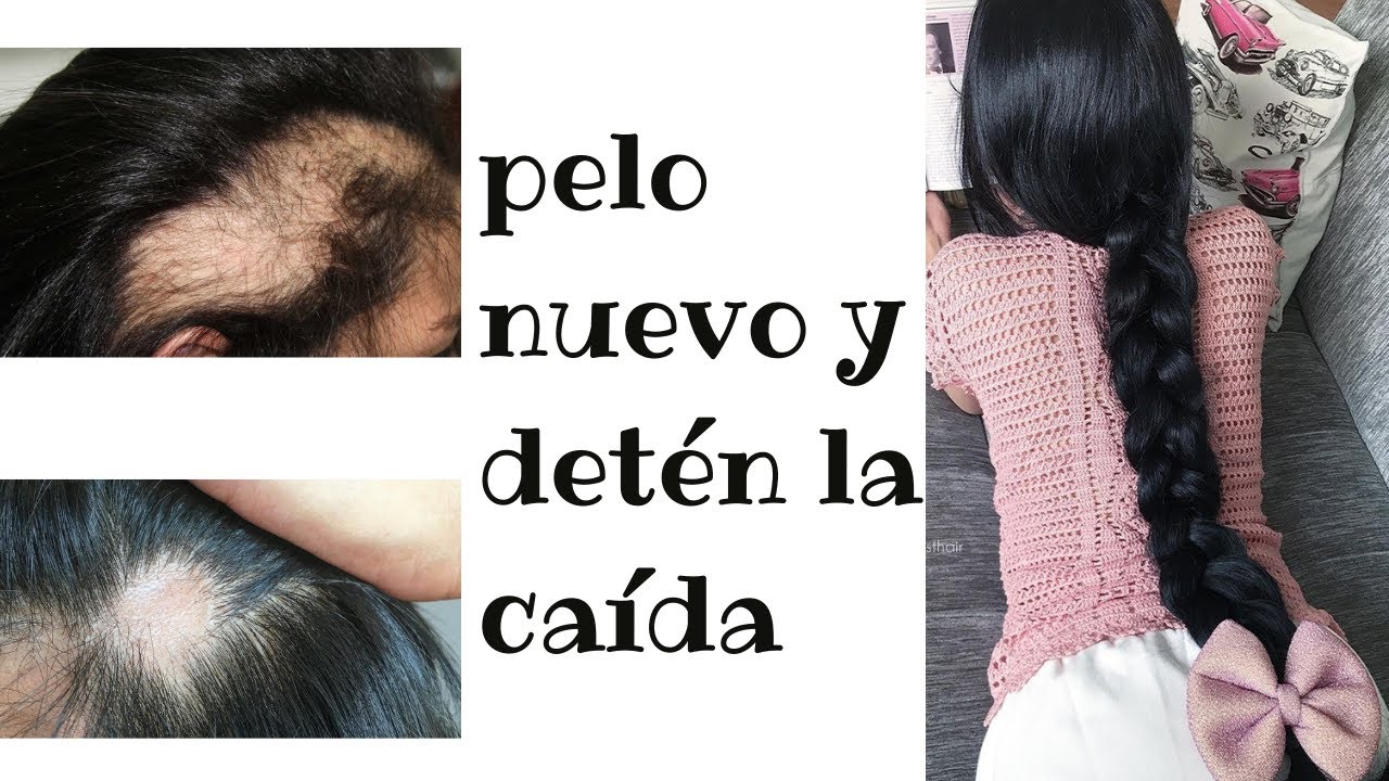 COMO DETENER LA CAIDA DEL PELO Y LOGRAR QUE TE NAZCA CABELLO NUEVO - *Cabello nuevo en 7 días*