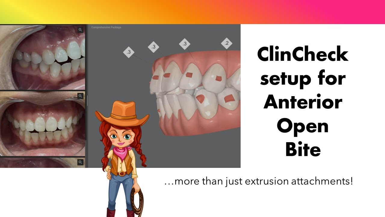 Invisalign ClinCheck - Anterior Open bite