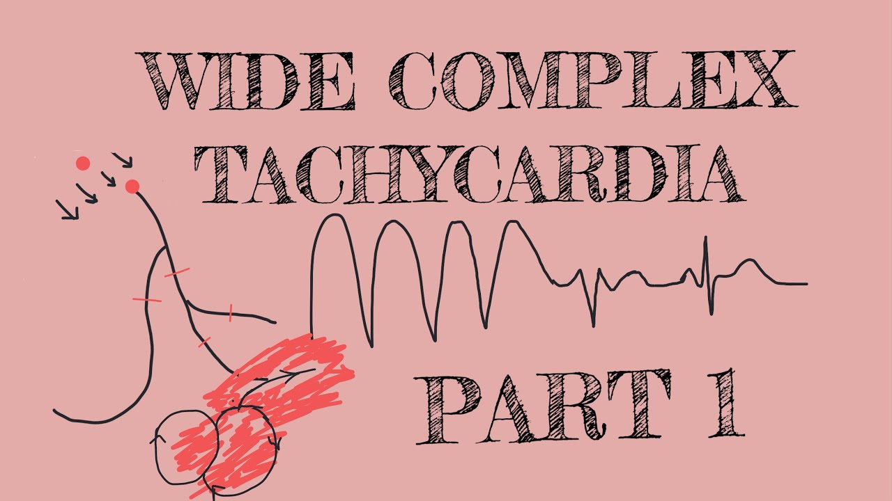 Wide complex tachycardia - Part 1