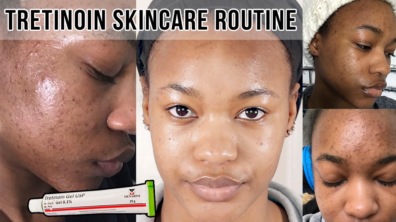 HOW TO: GET RID OF ACNE & ACNE SCARS | TRETINOIN SKINCARE ROUTINE ♡ 