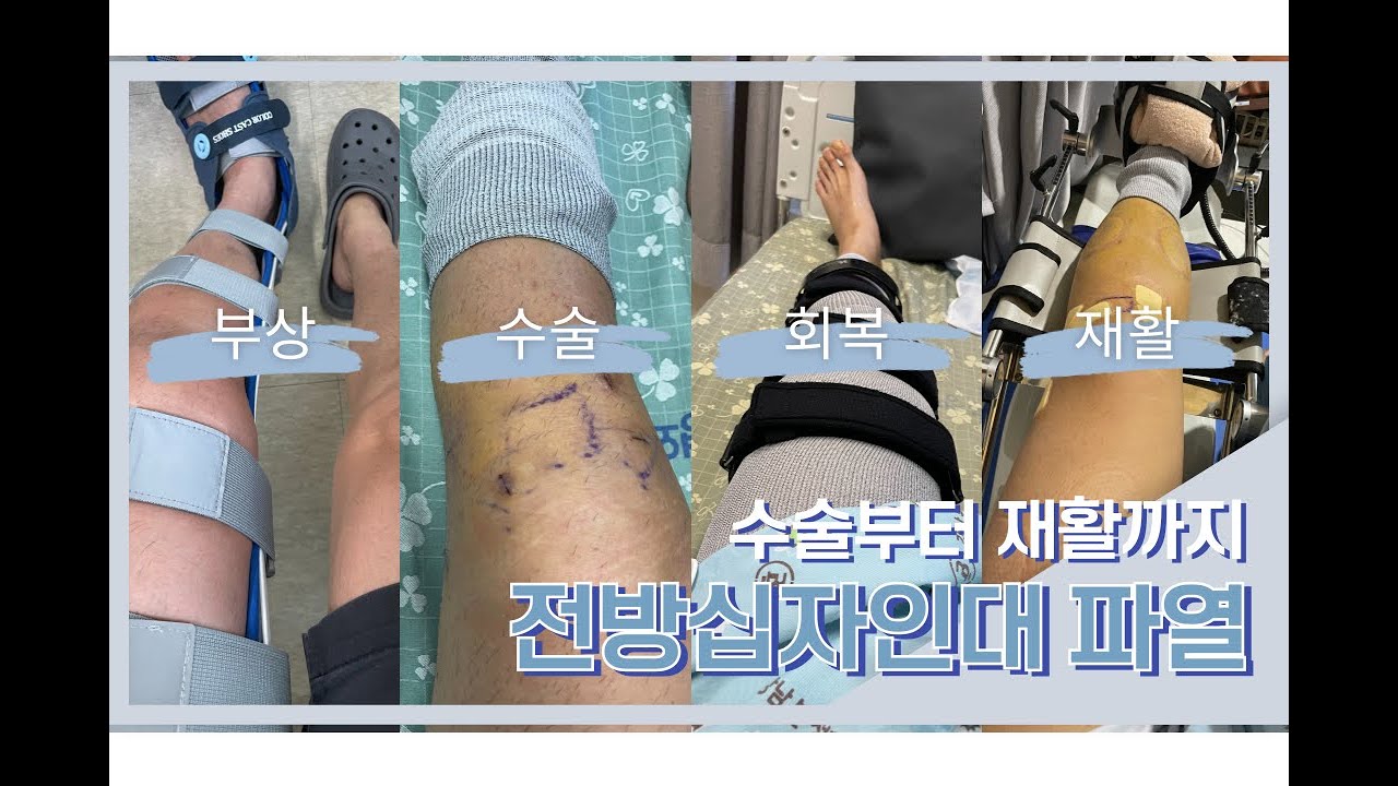[재활일기#1] 전방십자인대 파열 | 반월상 연골판 파열 | 전방십자인대 재건술 | 반월상연골 봉합술 | 수술기록 | 수술 후 0~2주차 | 수술 후기