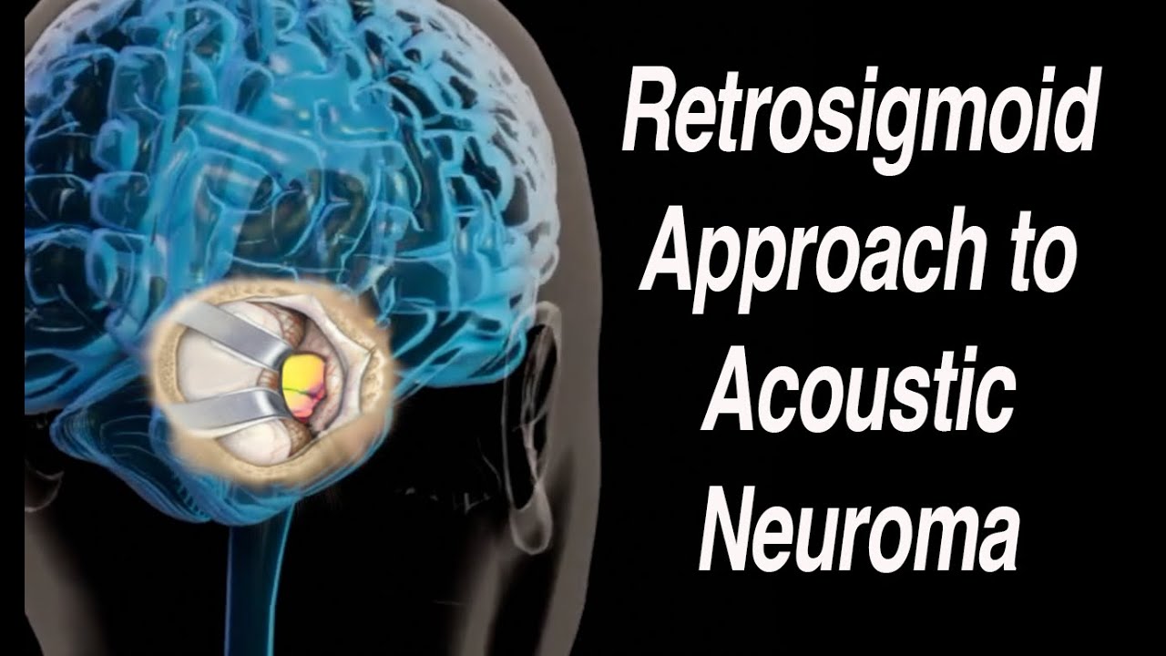 Retrosigmoid (or Suboccipital) Approach to Acoustic Neuroma Surgical Removal